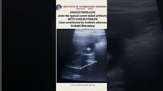 Cholesterolosis with cholelithiasis ultrasound ultrasoundlife pocus [upl. by Ern]