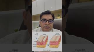 Subcision RF Treatment For Acne Scars  Acne Scar Treatments [upl. by Wilde]