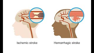 Recognizing hemorrhagic strokes–Neurology Masterclass [upl. by Willy130]