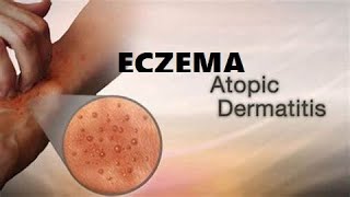 What is Eczema A Type of skin condition I Atopic Dermatitis I Allergic eczema I Neurodermatitis [upl. by Greenland]