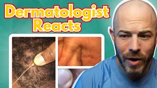 Dermatologist reacts to Viral Pimple Popping TikToks [upl. by Jess]