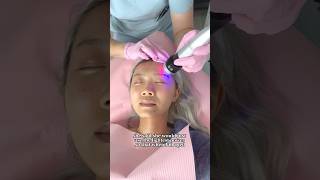 Micro needling vlog👩‍⚕️ microneedling skintreatment beauty [upl. by Nednerb630]