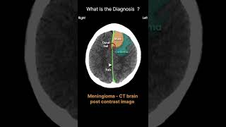 Meningioma CT brainpost contrast image Acute CT Brain Intracranial masses75radiologychannel007 [upl. by Margarete]