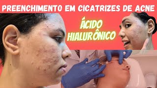 Preenchimento de cicatrizes de acne com ácido hialurônico [upl. by Ahsina]