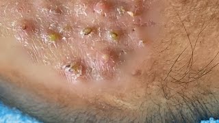 Big Cystic Acne Blackheads Extraction Blackheads amp Milia Whiteheads Removal Pimple Popping 059 [upl. by Ilehs755]