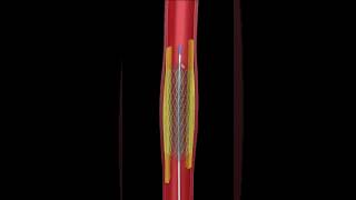 THE ULTIMATE ANGIOPLASTY ANIMATION  SEE HOW ITS DONE UP CLOSE [upl. by Isyak]