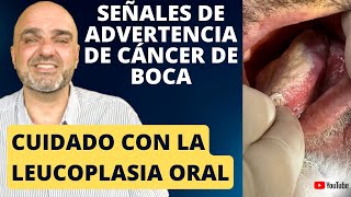 Leucoplasia Oral ¡Alerta Importante en la Salud Bucal [upl. by Saundra]