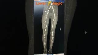 CT Lower limb🦵 Angiogram Angiogram shorts angiogram radiology [upl. by Annoya]