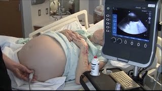 Ultrasound for Paracentesis  BAVLS [upl. by Ycal883]