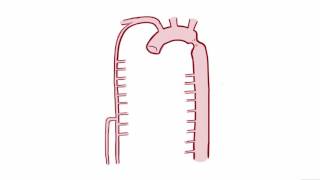 Coarctation of the Aorta CoA repair causes symptoms amp pathology [upl. by Nojram]