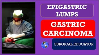 GASTRIC CARCINOMA How to DIAGNOSE amp TREAT EPIGASTRIC LUMPS Abdominal Lumps [upl. by Rivalee]