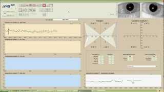 eVNG Caloric Test Demo [upl. by Iney]