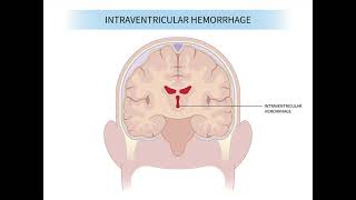 Intraventricular Haemorrhage mrcpch Recall Communication [upl. by Elaweda]