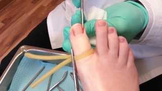 Ingrown toenail surgery [upl. by Junno]