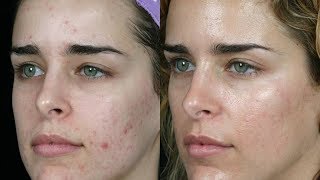 ELIMINA EL ACNE CON AZUFRE – RESULTADOS INCREIBLES [upl. by Nageem17]