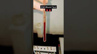 Erythrocyte Sedimentation Rate  ESR  What does the ESR test show What does high ESR mean [upl. by Avilla]