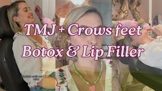 TMJ  Crows Feet Botox and Lip Filler [upl. by Imis]