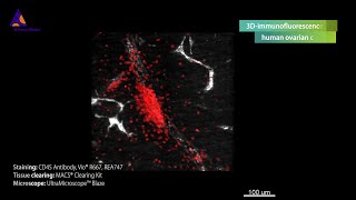 3Dimmunofluorescence of a human ovarian cancer stained with CD45 Antibody [upl. by Raamaj]