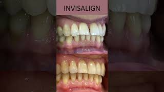 Invisalign Cost  Before And After  Gapped Teeth  London UK [upl. by Oribelle]