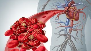 DVT and Pulmonary embolism  DVT animation  3D animation video [upl. by Nodlehs669]