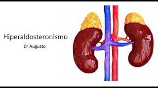 Hiperaldosteronismo Etiología Cuadro clínico Diagnóstico y Tratamiento [upl. by Ajan457]