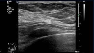 Breast Ultrasound  normal anatomy [upl. by Ardisj]