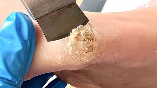 Callus removal from feetampFoot scraping dead skin【Xiao Yan pedicure】stress 46 [upl. by Haelat919]