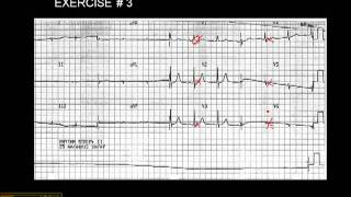 1215 Lead ECG Exercise  3 [upl. by Tshombe]