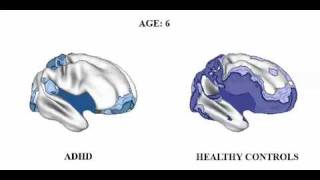 Brain matures a Few Years Late in ADHD but follows Normal pattern [upl. by Ennoira523]