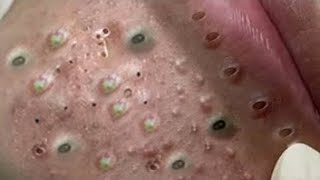 Big Cystic Acne Blackheads Extraction Blackheads amp Milia Whiteheads Removal Pimple Popping  136 [upl. by Ava429]