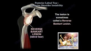 Posterior Labral Tear Shoulder Instability  Everything You Need To Know  Dr Nabil Ebraheim [upl. by Bobby]