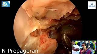 Module 3 Endoscopic Orbital decompression and intraorbital dissection [upl. by Bilow109]