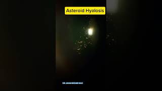 Asteroid Hyalosis eyes eyedisease [upl. by Yuji148]