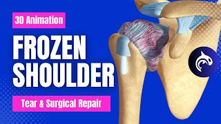 Frozen Shoulder Adhesive Capsulitis [upl. by Ireva]