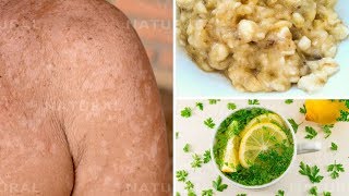 3 Natural Remedies for Treating Tinea Versicolor at Home Pityriasis Versicolor [upl. by Ilrahs]