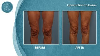 Lipo of knees [upl. by Stets]