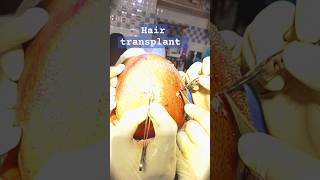 After hair transplant surgery hairecare shortviralvideo explorepage [upl. by Martreb77]