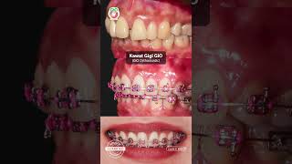 Kawat Gigi GiO  GiO Orthodontics [upl. by Nylsoj]