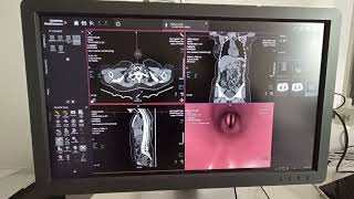 ct virtual bronchoscopy Bangla [upl. by Dunston]