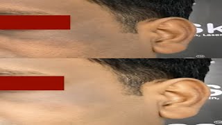 Treating Acanthosis Nigricans by Laser and Chemical Peel at SkinaaClinic treatingacanthosis short [upl. by Corotto]