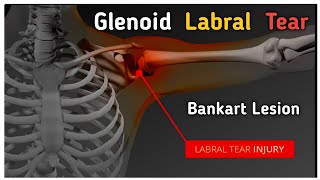 Glenoid labrum tear  Bankart lesion labraltear shoulderdislocation shorts [upl. by Etnuahs]