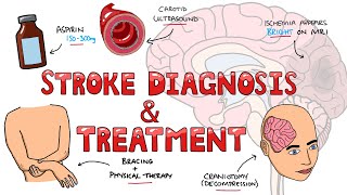 Stroke Diagnosis and Treatment  Acute and Long Term Treatment of Ischemic and Hemorrhagic Stroke [upl. by Juline]