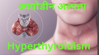 आयोडीन अल्पता 🔥 Hyperthyroidism [upl. by Atir]