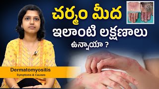 Dermatomyositis Telugu Symptoms amp Causes  Sindhura Kambhampati [upl. by Tezzil912]