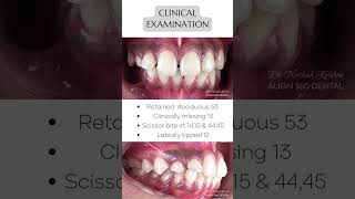 Orthodontist Madurai  Disimpaction of impacted Canine  Teeth Alignment Madurai [upl. by Eblehs]