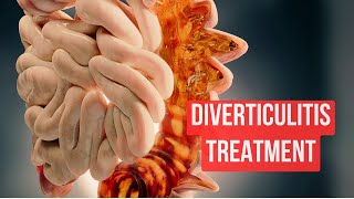 How To Treat Diverticulitis in 2024 [upl. by Nuawad]