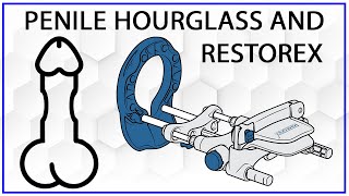 Treating Peyronies Hourglass With RestoreX [upl. by Heng86]