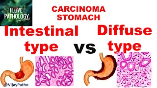 Carcinoma Stomach INTESTINAL VS DIFFUSE GASTRIC CANCER [upl. by Maretz]