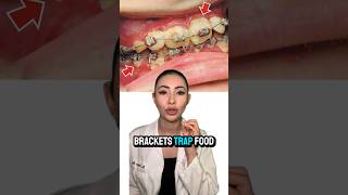 🤯 Braces can ruin your teeth Dentist Explains [upl. by Eecram]