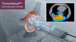 The TomoTherapy System vs Conventional Linacs [upl. by Junna924]